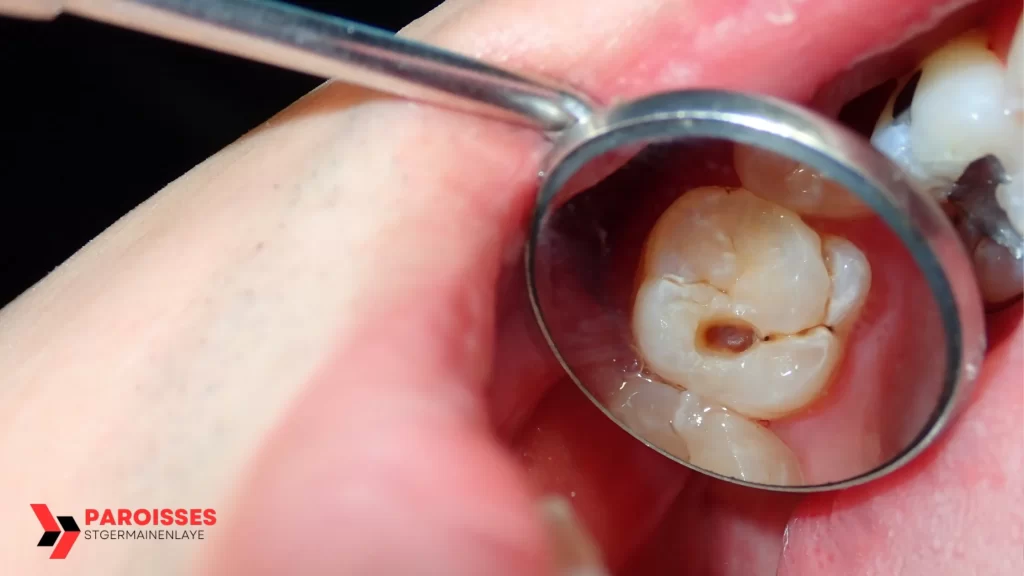 Close-up of an infected tooth under examination, illustrating How Long Until a Tooth Infection Kills You?