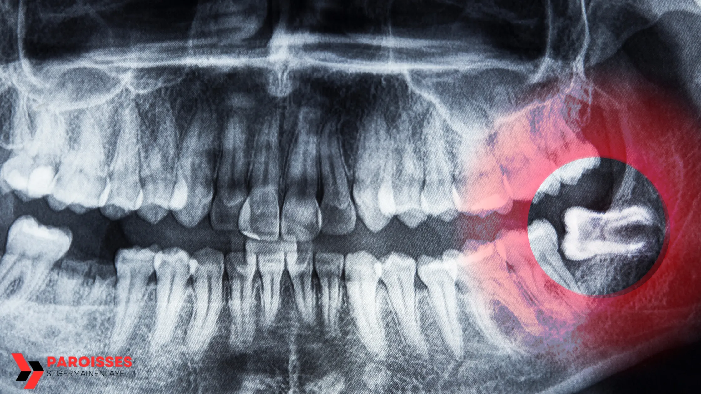 X-ray showing impacted wisdom teeth with a focus on whether can you keep your wisdom teeth despite dental issues like crowding or impaction.