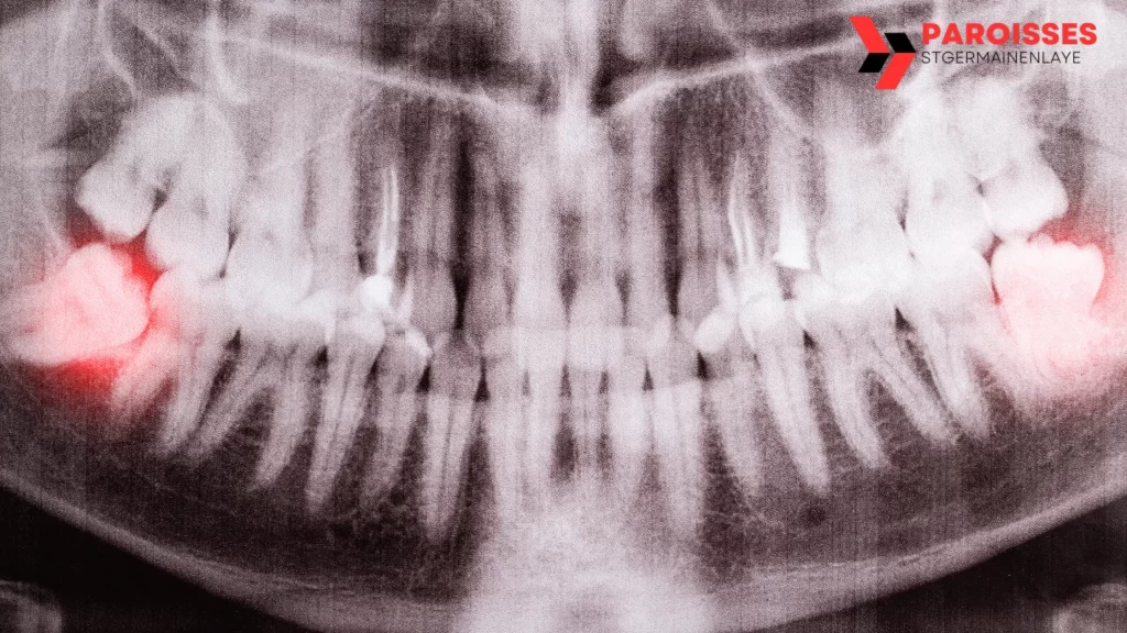 X-ray image showing impacted wisdom teeth highlighted in red, illustrating the common issue of whether can you keep your wisdom teeth in cases of impaction or potential dental problems.